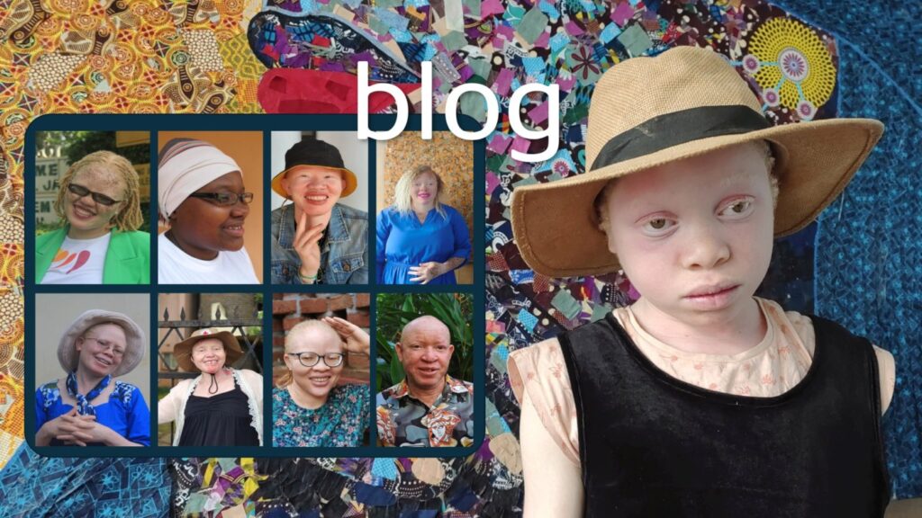 Albinism, a genetic condition, not a curse or a myth.